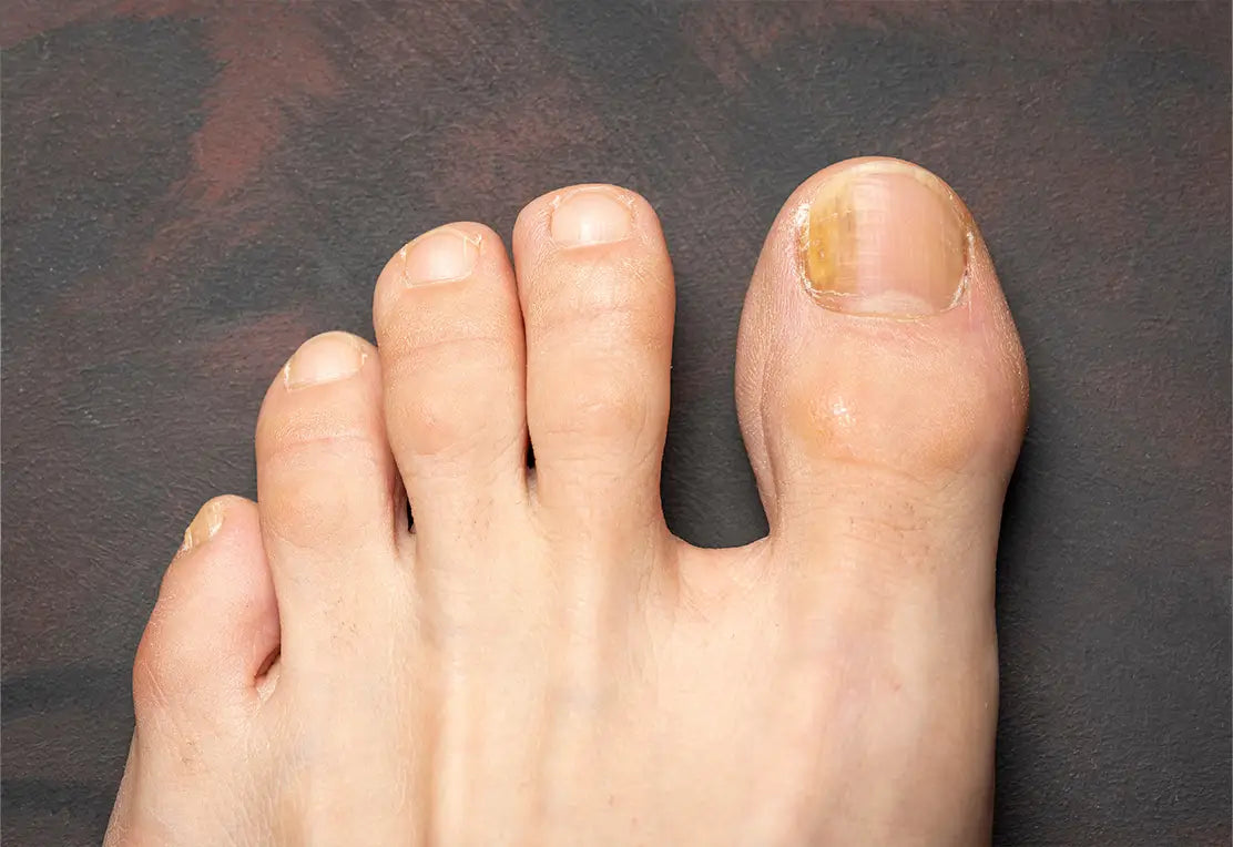 ¿Tenés hongos en las uñas? ¿Cómo reconocerlos y tratarlos sin salir de casa?