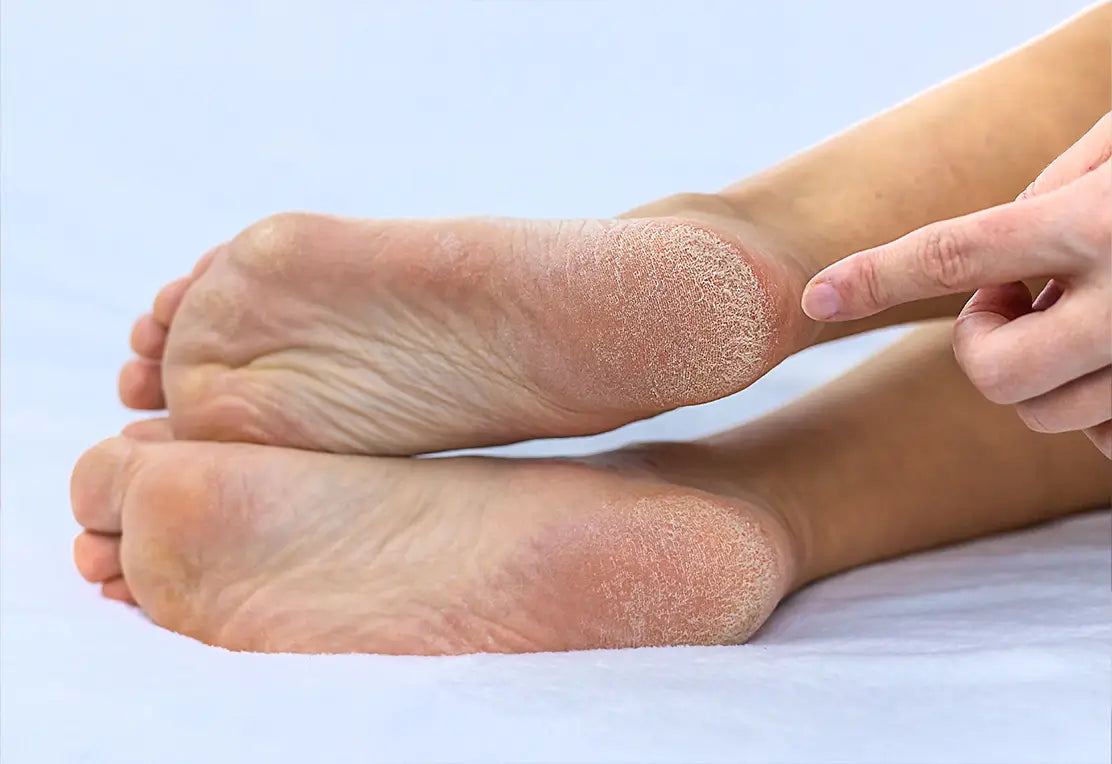 Tus pies están resecos y con grietas? Así empieza la mayoría de infecciones por hongos
