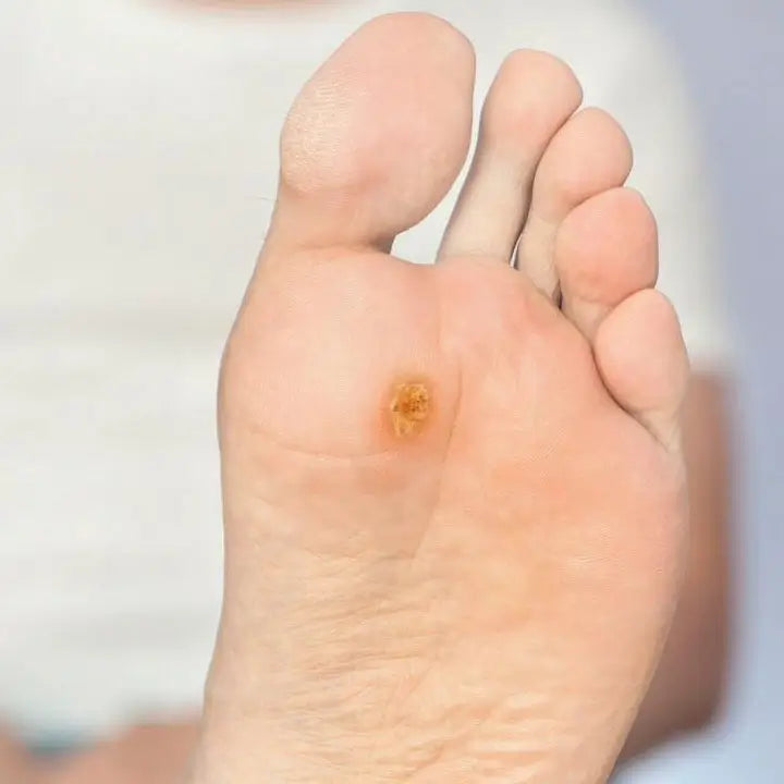 Úlceras o heridas