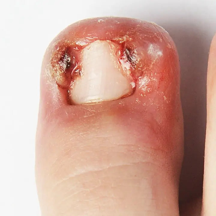 Seguimiento post-uñero