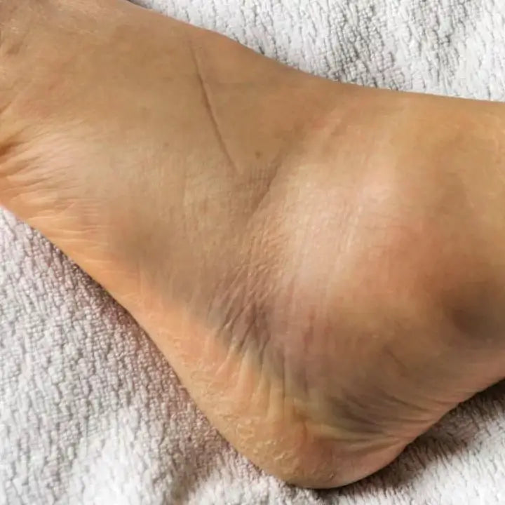 Lesiones de ligamentos y tendones que requieren soporte