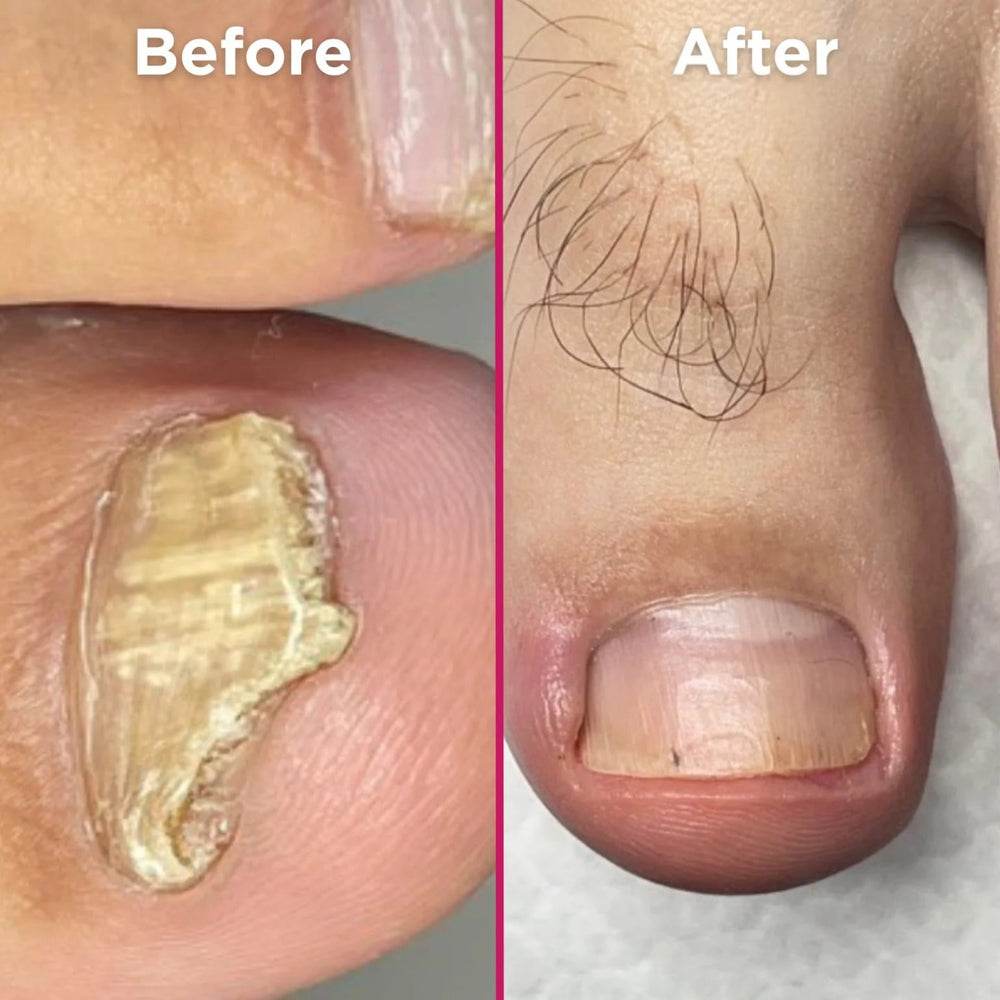 Tintura en Spray Antifúngica Para Uñas