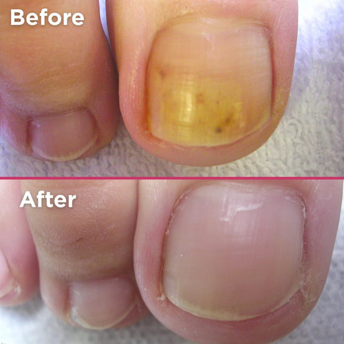 Tintura en Spray Antifúngica Para Uñas