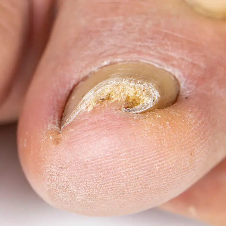 Uñas extremadamente curvas o pinzadas