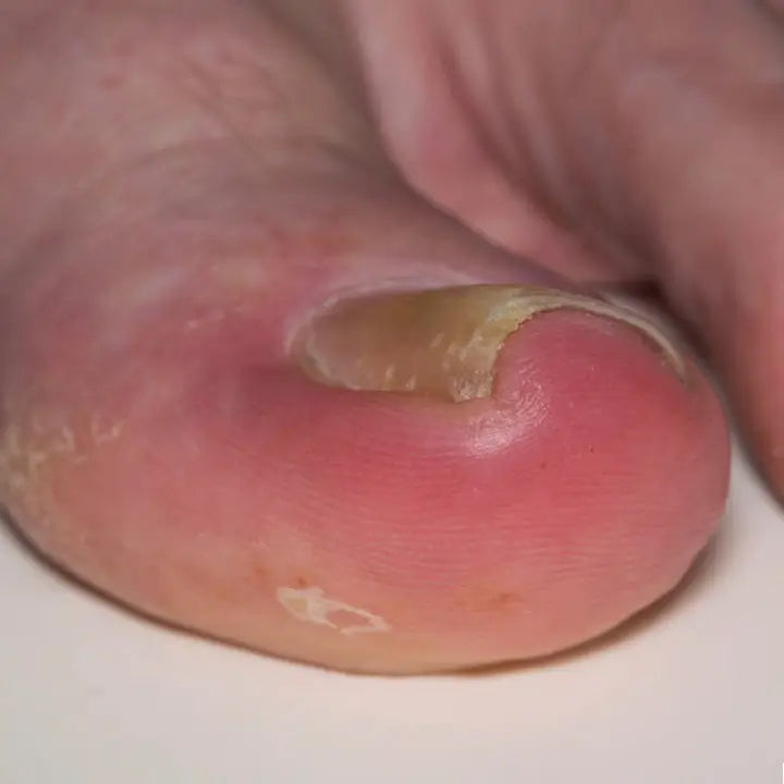 Uñeros frecuentes y recurrentes