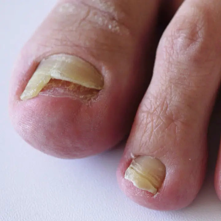Uñas dañadas por lesiones o traumatismos
