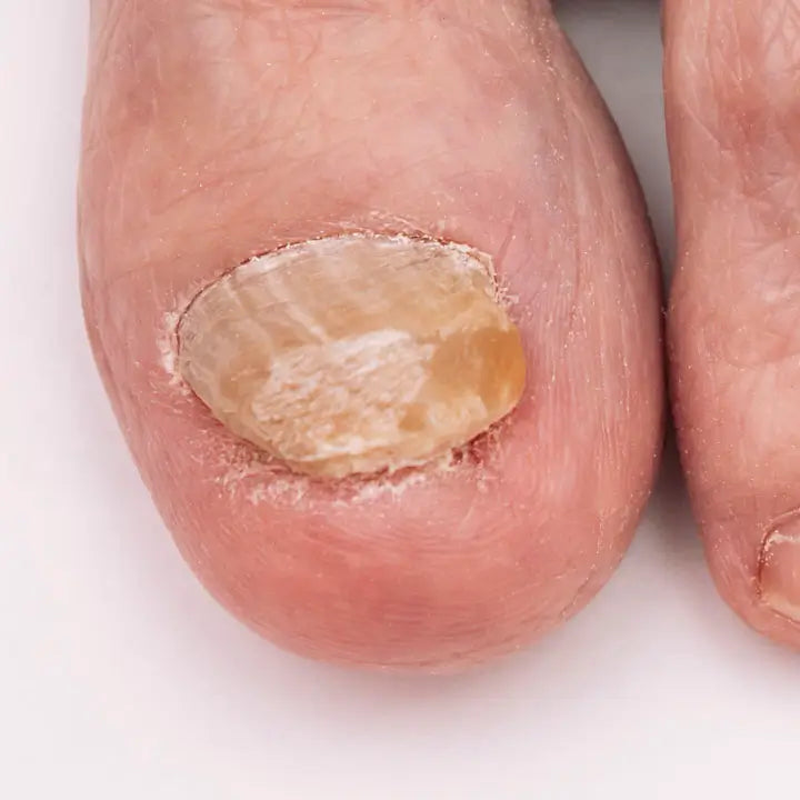 Uñas deformadas por Onicomicosis