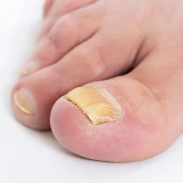Uñas gruesas o con onicomicosis