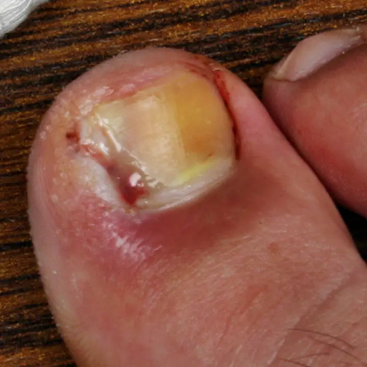 Infección extendida y compleja