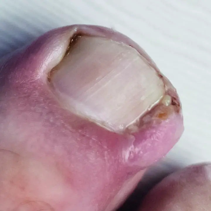 Múltiples uñeros en el mismo dedo