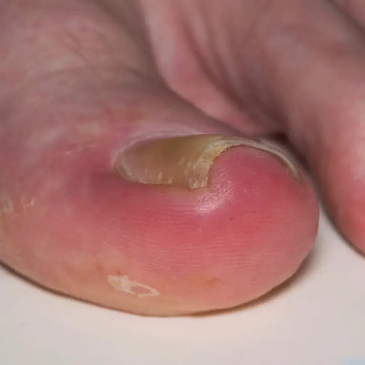 Inflamación notoria con enrojecimiento